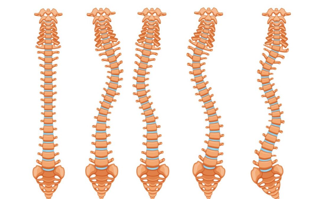 Bikram Yoga for Scoliosis