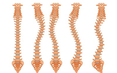 Bikram Yoga for Scoliosis
